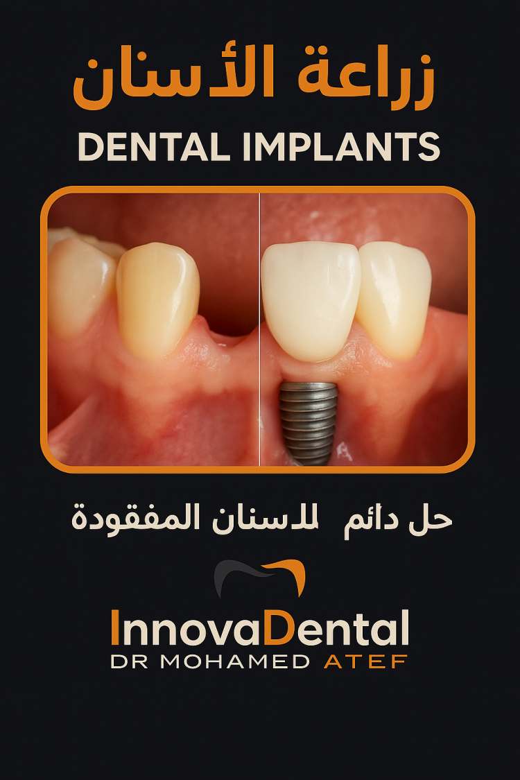 Dental implants
